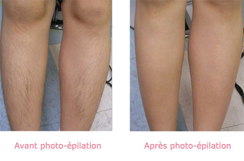 Photos avant/après Epilation Laser