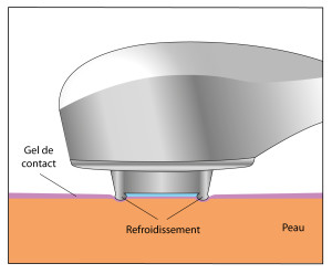 PAM refroidissement